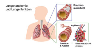 Pulmonale Komplikationen bei Querschnittlähmung verhindern