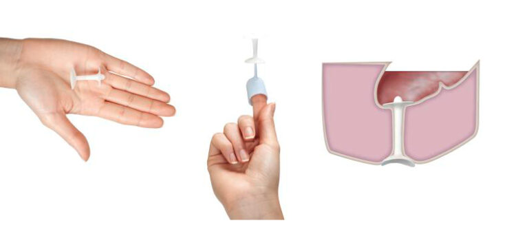 Bilder_ Hand_Palm_Insert sowie hand_applicator and insert_blue sowie ...