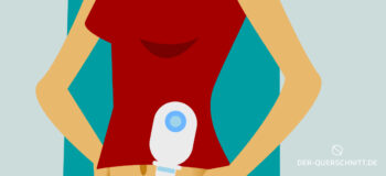 Stoma bei Querschnittlähmung: In der Entscheidungsphase reden, reden, reden – und Probetragen