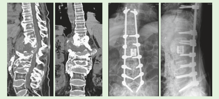 Neuroarthropathie: Unmerkliche Abnutzung von Wirbelsäule und Gelenken