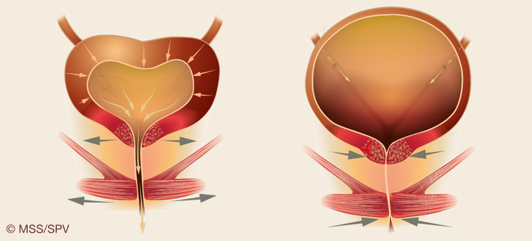 Detrusor-Sphinkter-Dyssynergie: Reflexentleerung als Therapieoption